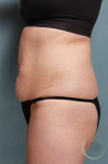 Coolsculpting Case 2 Before